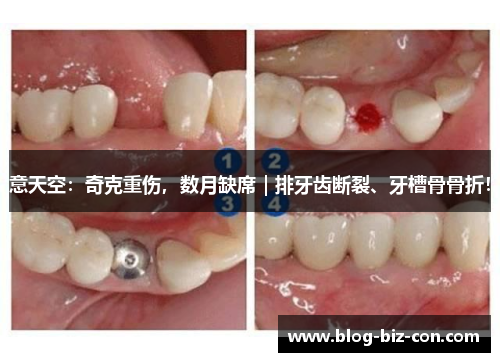 意天空：奇克重伤，数月缺席｜排牙齿断裂、牙槽骨骨折！